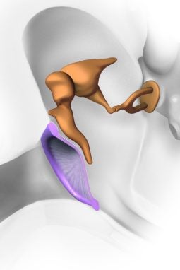 Middle Ear Implant Solutions